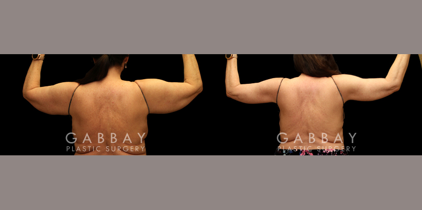 Arm lift with lipo by Dr. Joubin Gabbay — before and after