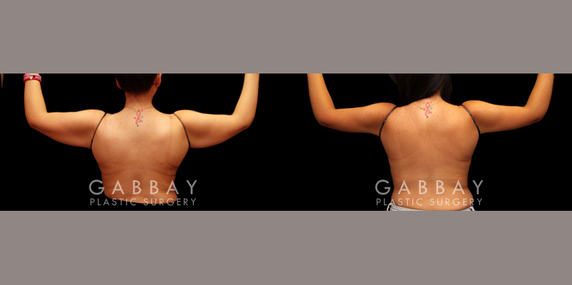 Arm Lift by Dr. Joubin Gabbay — before and after