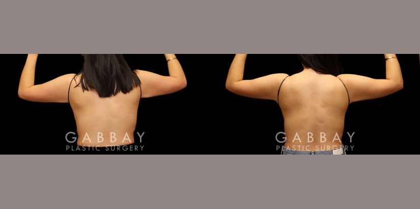 Mini arm lift by Dr. Joubin Gabbay — before and after