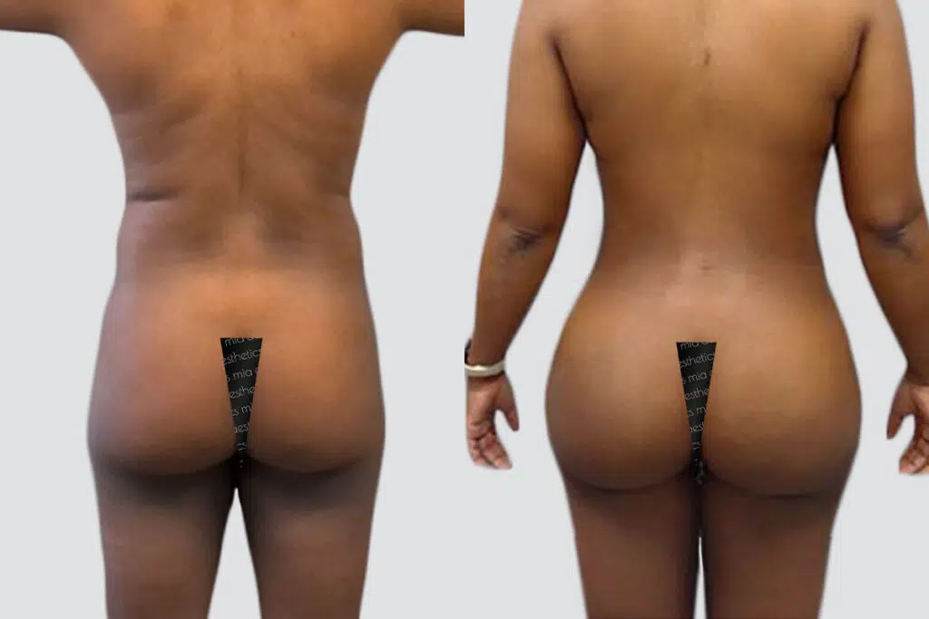BBL before and after - after