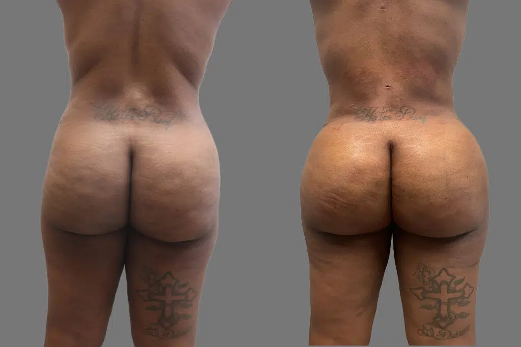 BBL before and after - after