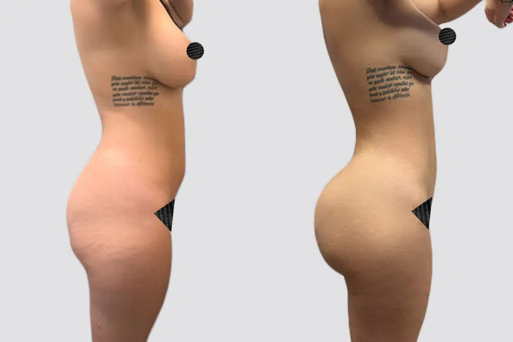 BBL before and after - after