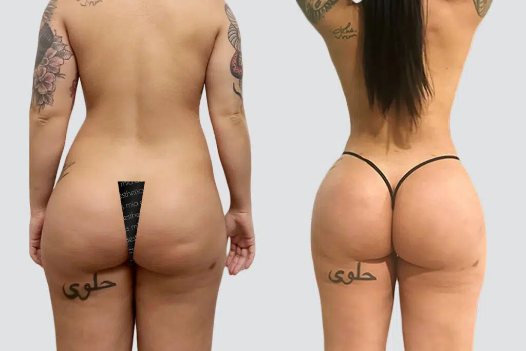 BBL before and after - after