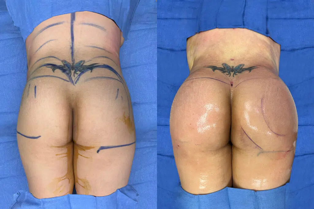 BBL before and after - after