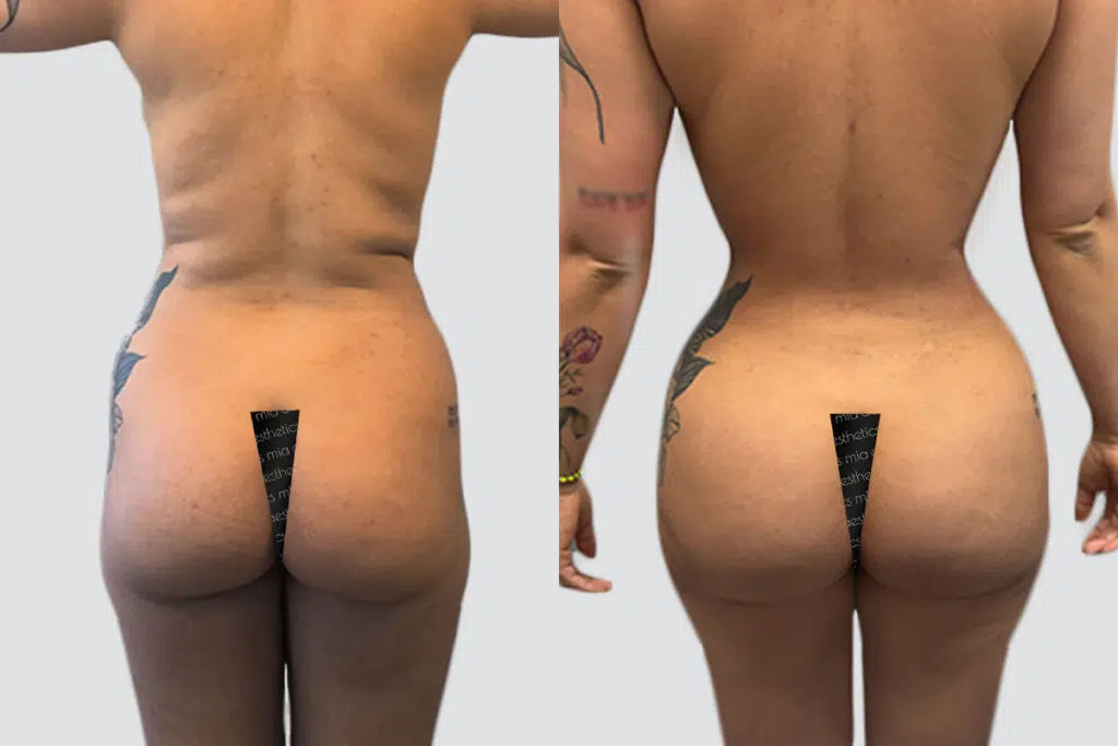 BBL before and after - before