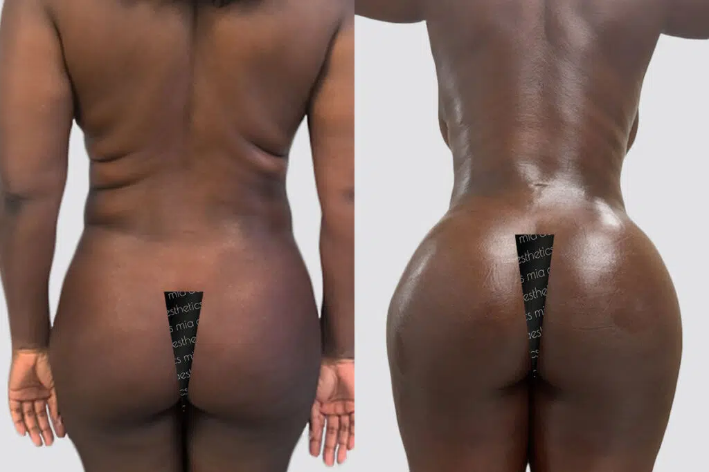 BBL before and after - before