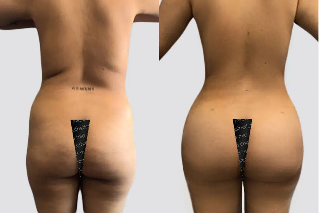 BBL before and after - before