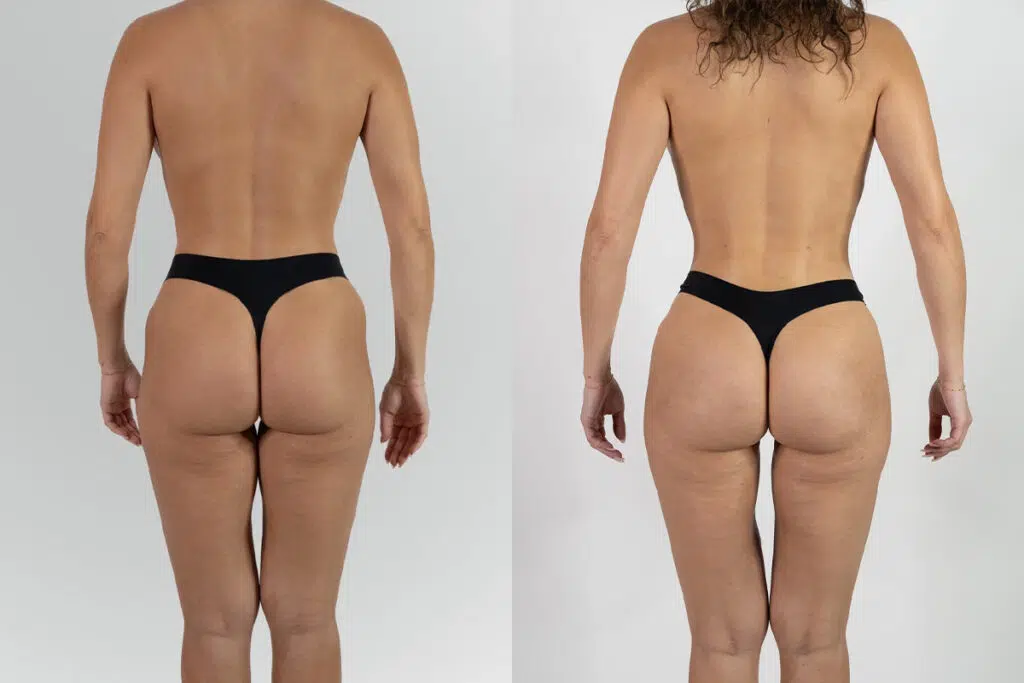 BBL before and after - before