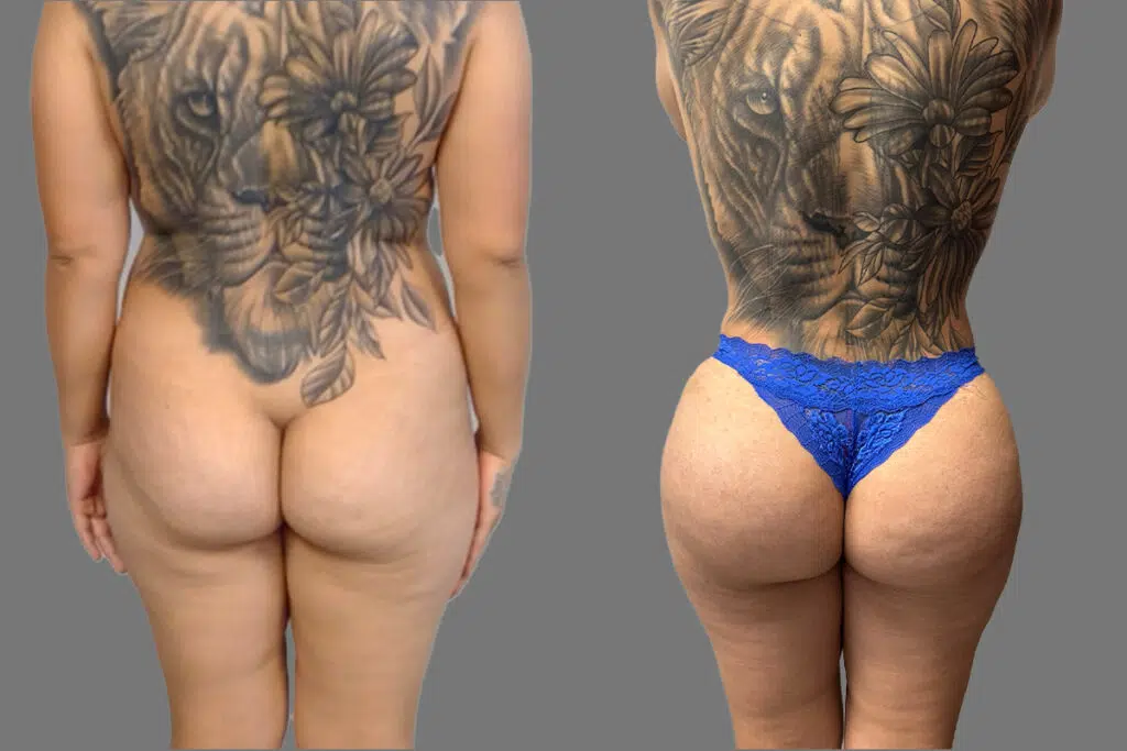 BBL before and after - before