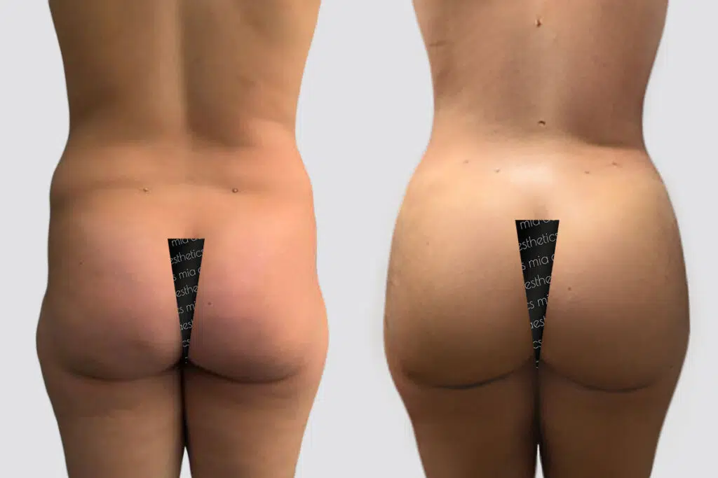 BBL before and after - before