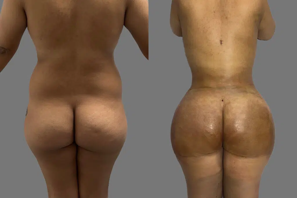 BBL before and after - before