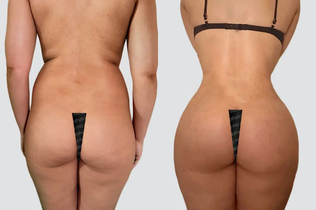 BBL before and after - before