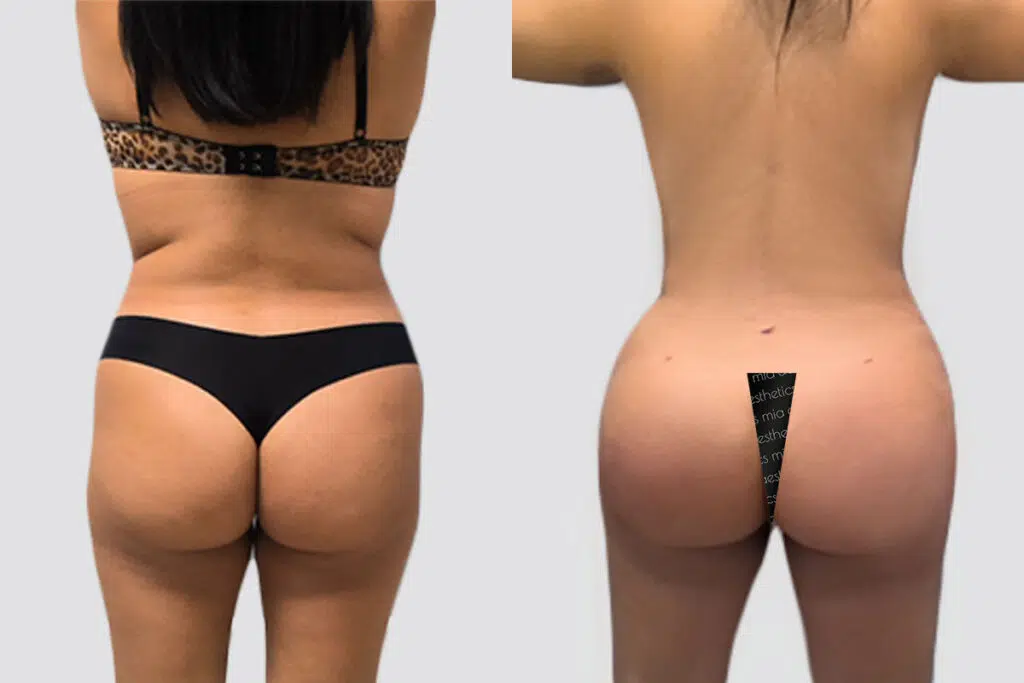 BBL before and after - before