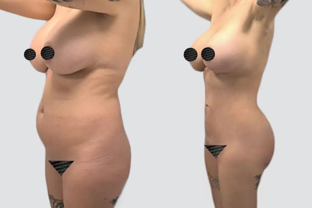 BBL before and after - before