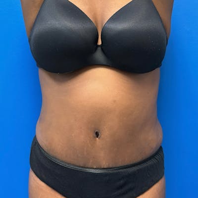 Tummy Tuck before and after - after