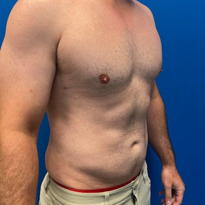 Liposuction before and after - after