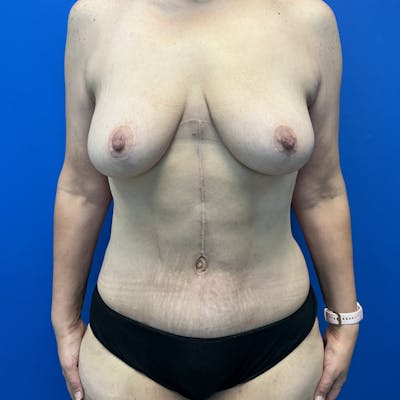 Tummy Tuck before and after - after