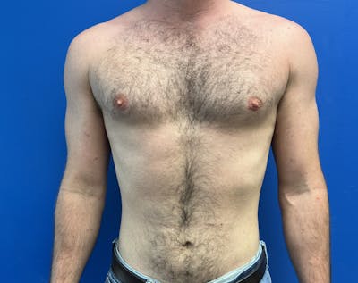Liposuction before and after - after