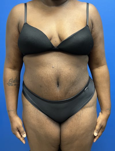 Liposuction before and after - after