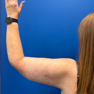 Arm Lift before and after - after