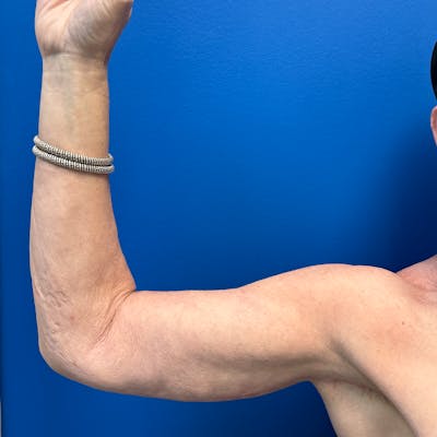 Arm Lift before and after - after