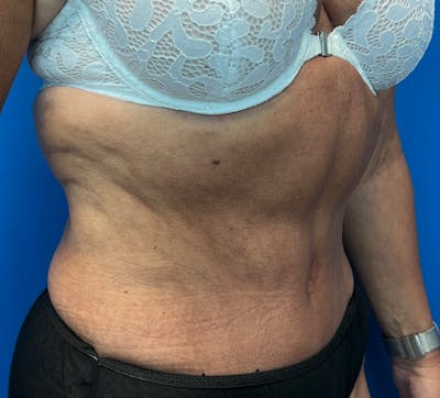 Tummy Tuck before and after - after