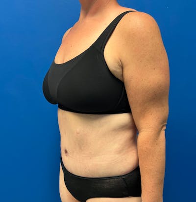 Tummy Tuck before and after - after