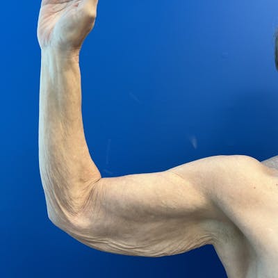 Arm Lift before and after - before