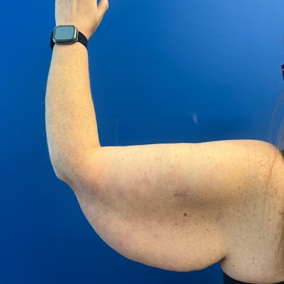 Arm Lift before and after - before
