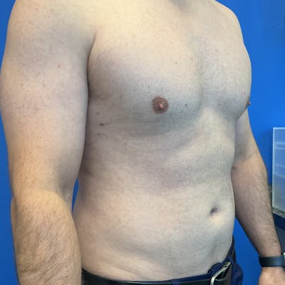 Liposuction before and after - before