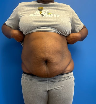 Liposuction before and after - before