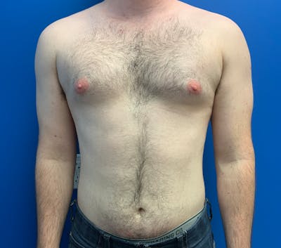 Liposuction before and after - before