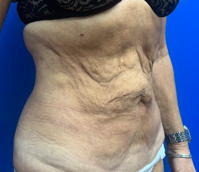Tummy Tuck before and after - before