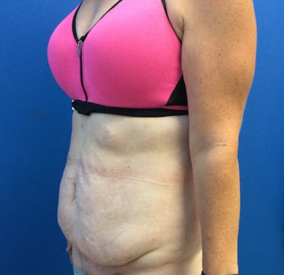 Tummy Tuck before and after - before