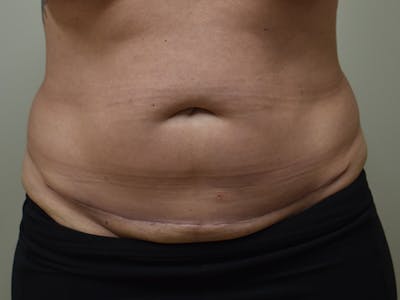 Tummy Tuck by Dr. Mark Sofonio — after