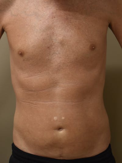 Liposuction by Dr. Mark Sofonio — after