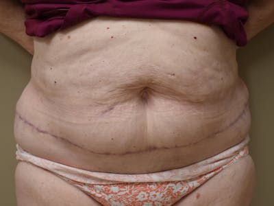 Tummy Tuck by Dr. Mark Sofonio — after
