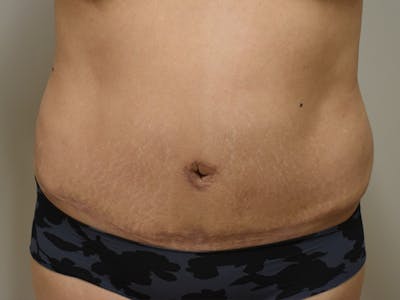 Tummy Tuck by Dr. Mark Sofonio — after