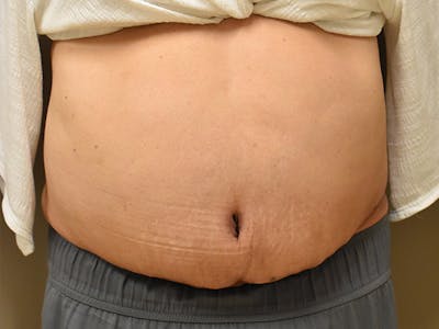 Tummy Tuck by Dr. Mark Sofonio — after