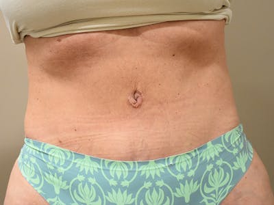 Liposuction by Dr. Mark Sofonio — after