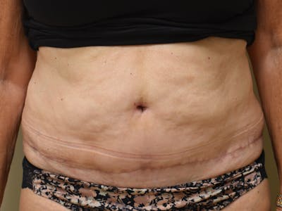 Tummy Tuck by Dr. Mark Sofonio — after