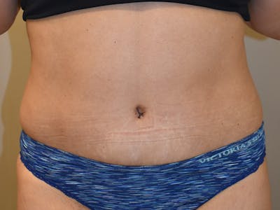 Tummy Tuck by Dr. Mark Sofonio — after