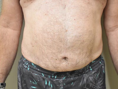 Liposuction by Dr. Mark Sofonio — after