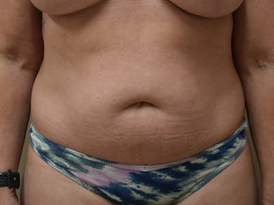 Tummy Tuck by Dr. Mark Sofonio — after