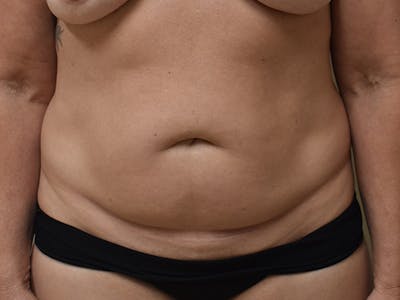 Tummy Tuck by Dr. Mark Sofonio — before