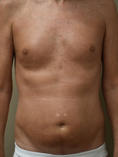 Liposuction by Dr. Mark Sofonio — before