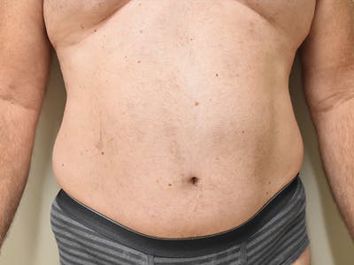 Liposuction by Dr. Mark Sofonio — before
