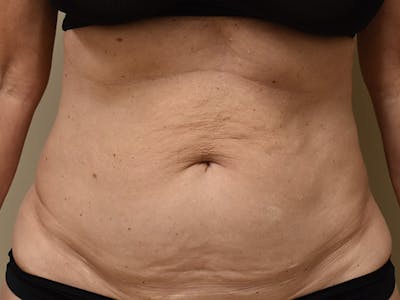 Liposuction by Dr. Mark Sofonio — before