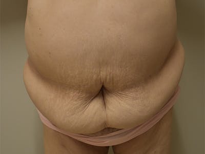 Tummy Tuck by Dr. Mark Sofonio — before