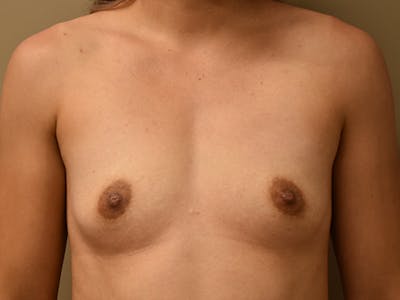 Breast Augmentation by Dr. Mark Sofonio — before